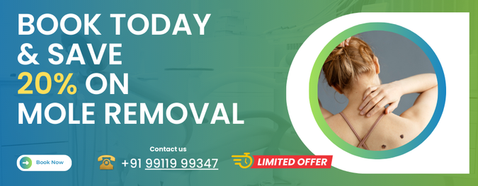 Book Today & Save 20% on Mole Removal