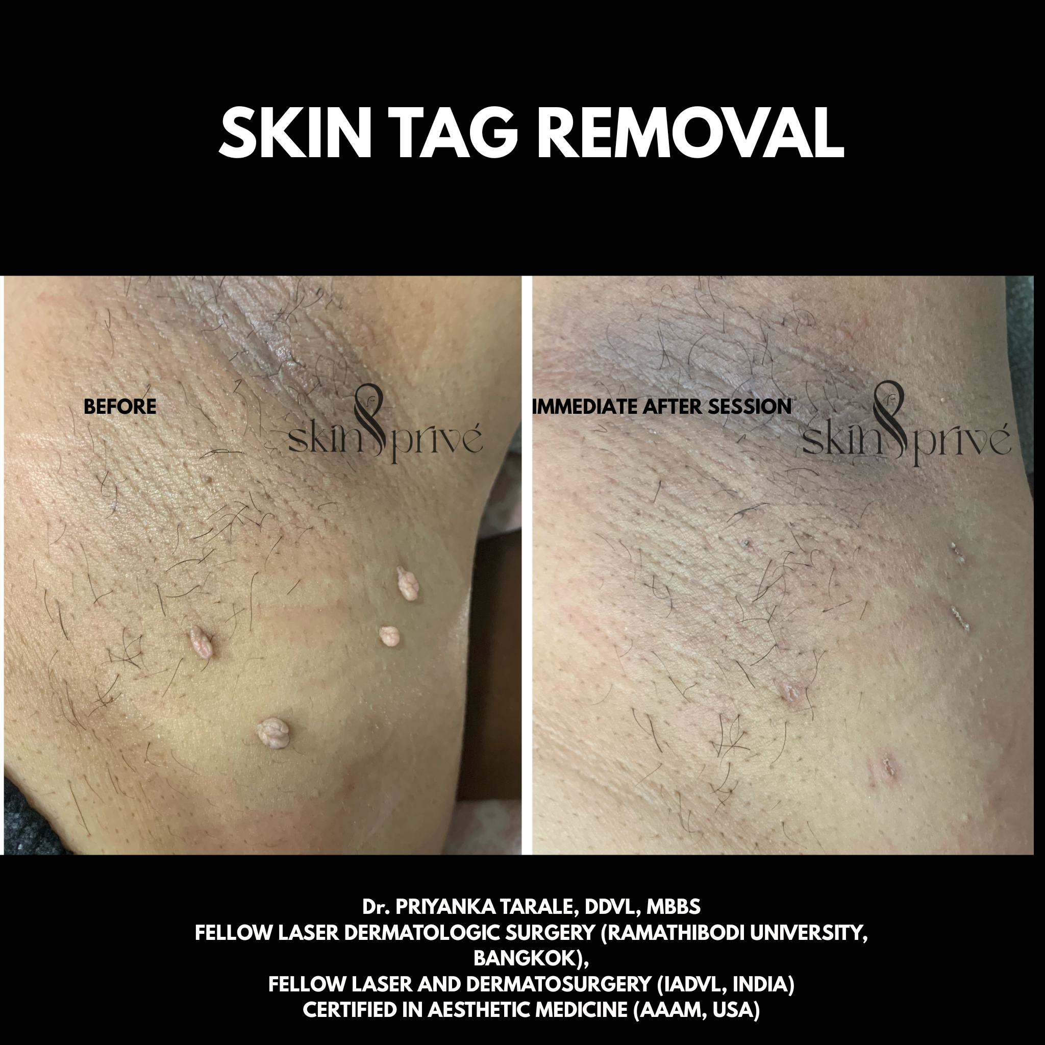 Skin Tag Removal Skin Tag Removal