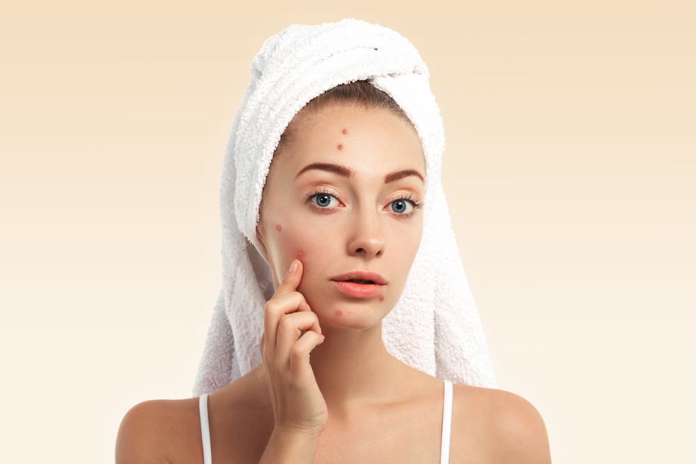 Why Your Acne Isn’t Going Away Even After Using Medicines
