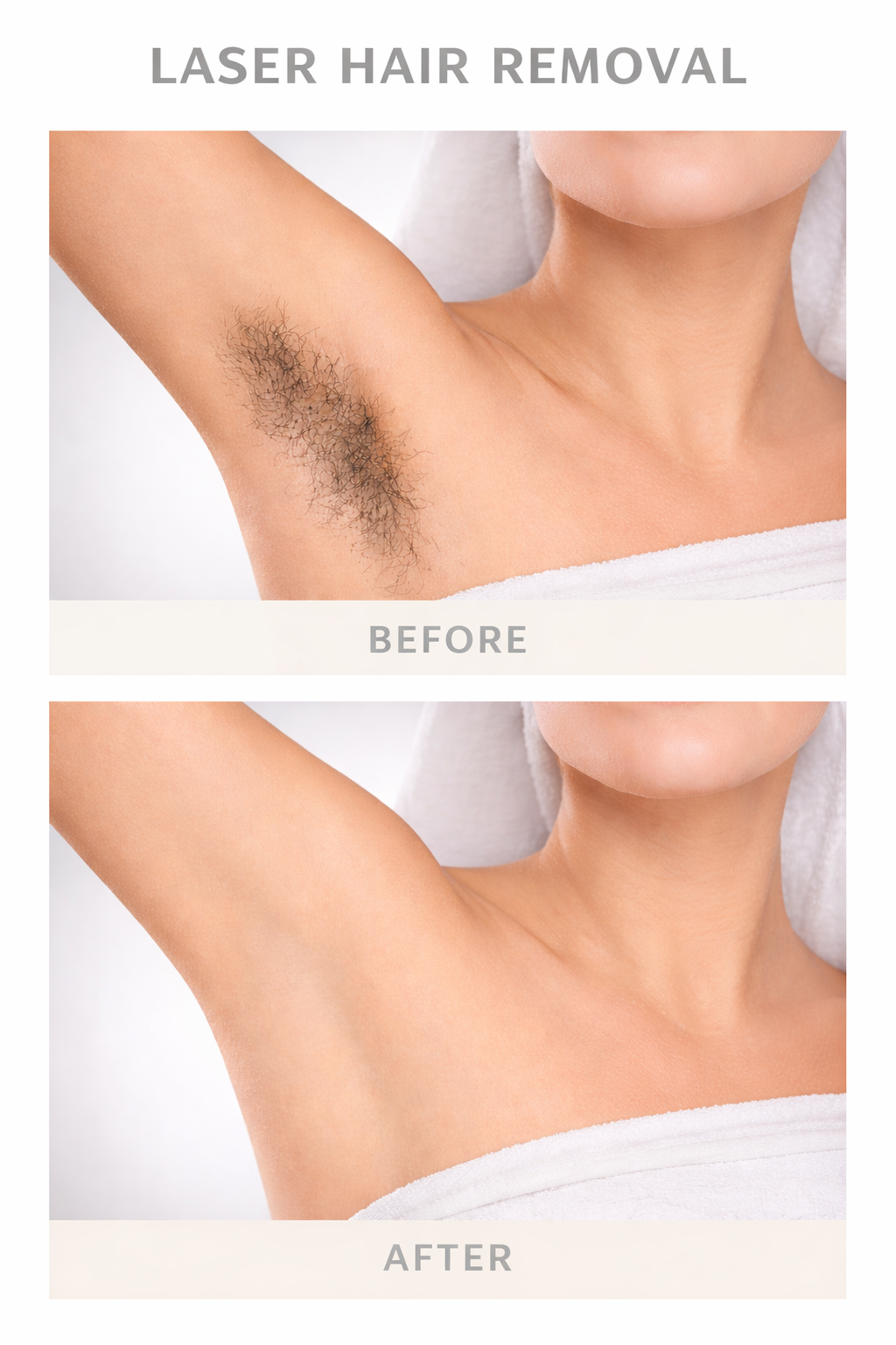 Laser Hair Removal