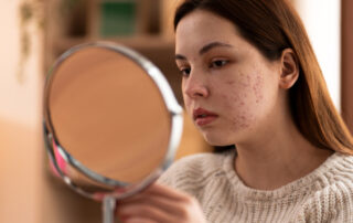 Hormonal Acne in Your 20s What Gen Z Needs