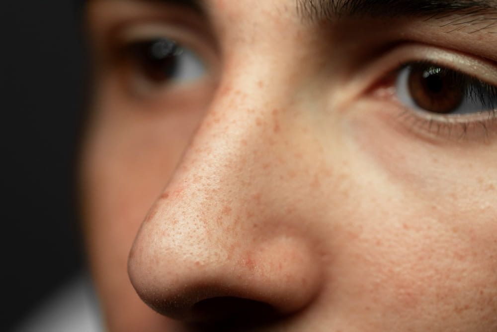 How to Reduce the Appearance of Enlarged Pores How to Reduce the Appearance of Enlarged Pores