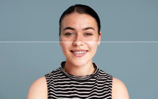 Acne Marks vs Acne Scars Treatment