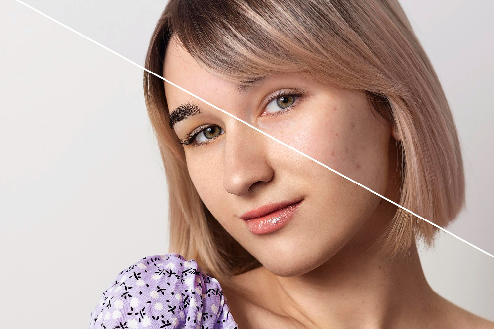 Acne Marks